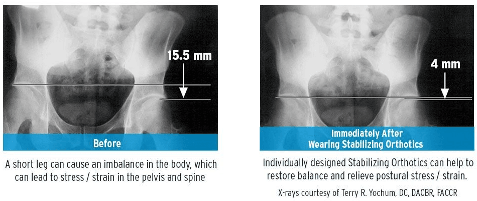 Image of an xray showing before and after results with custom orthotics