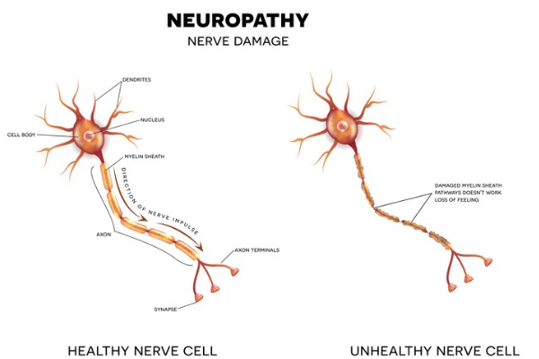 Diagram displaying a healthy nerve and a nerve that has been damaged by neuropathy
