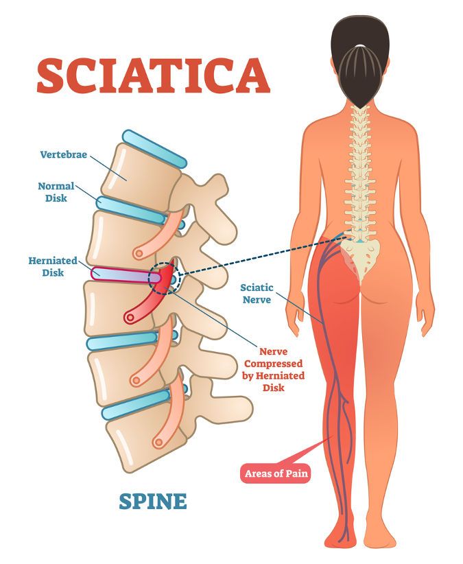 Illustration shows where the spine is affected by sciatica as a guide to the best treatment for sciatica.