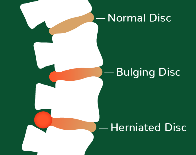 A graphic showing the differences between a herniated disc and a bulging disc.