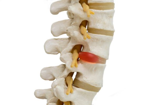 Spine with a herniated disc