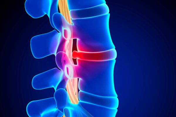 X-ray showing a herniated disc