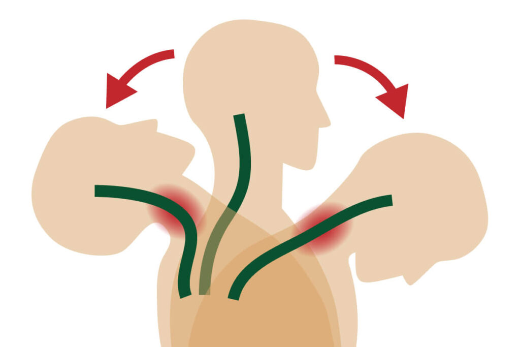 A graphic showing the movement of how whiplash happens. 