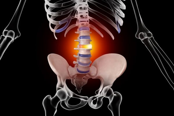 What is a herniated disc and what does it look like?